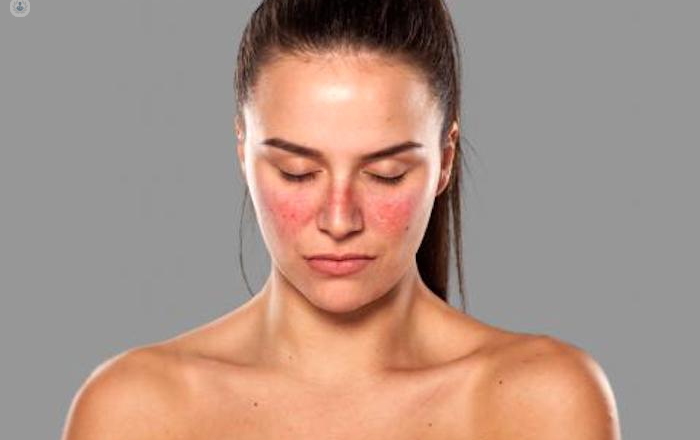 El lupus es un enemigo silencioso